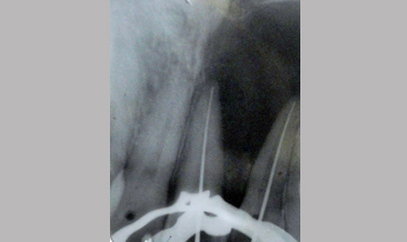 Dental jewellery treatment in Anand                        